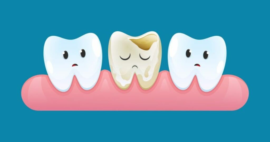 What does it mean when you dream about a broken tooth?